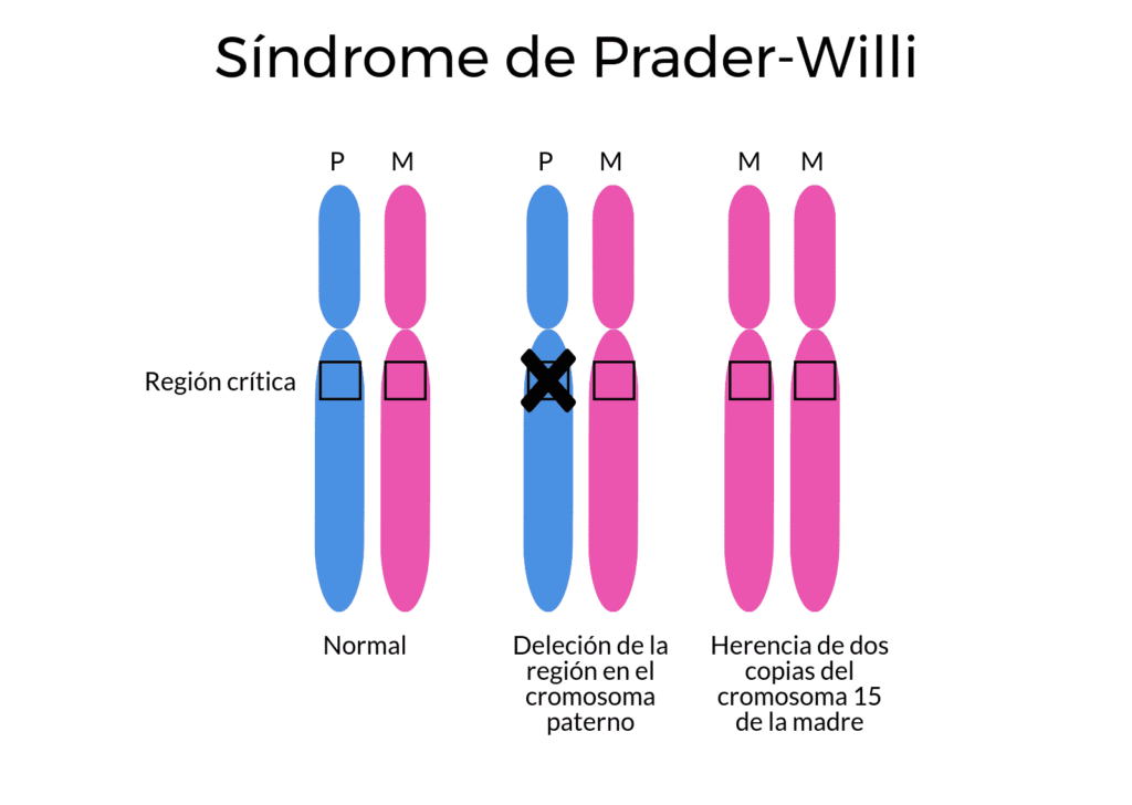 síndrome de Prader Willi